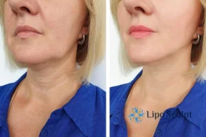 Double chin before and after Hi-Fu treatment 4 Book your double chin treatment Hanworth today! We are here to help!
