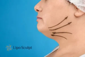 Double chin before and after Hi-Fu treatment 3 Boost your confidence with a Double chin treatment Hanworth