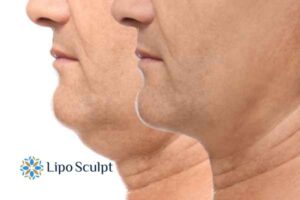 Double chin before and after Hi-Fu treatment 2 Double chin treatment Hanworth from Lipo Sculpt - feel more confident today!