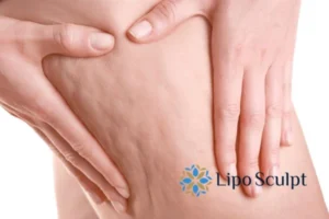 CoolSculpting for Legs: The Innovative Approach to Redefining Your Legs 5 Start your journey today book your coolsculpting treatment Hanworth online today!