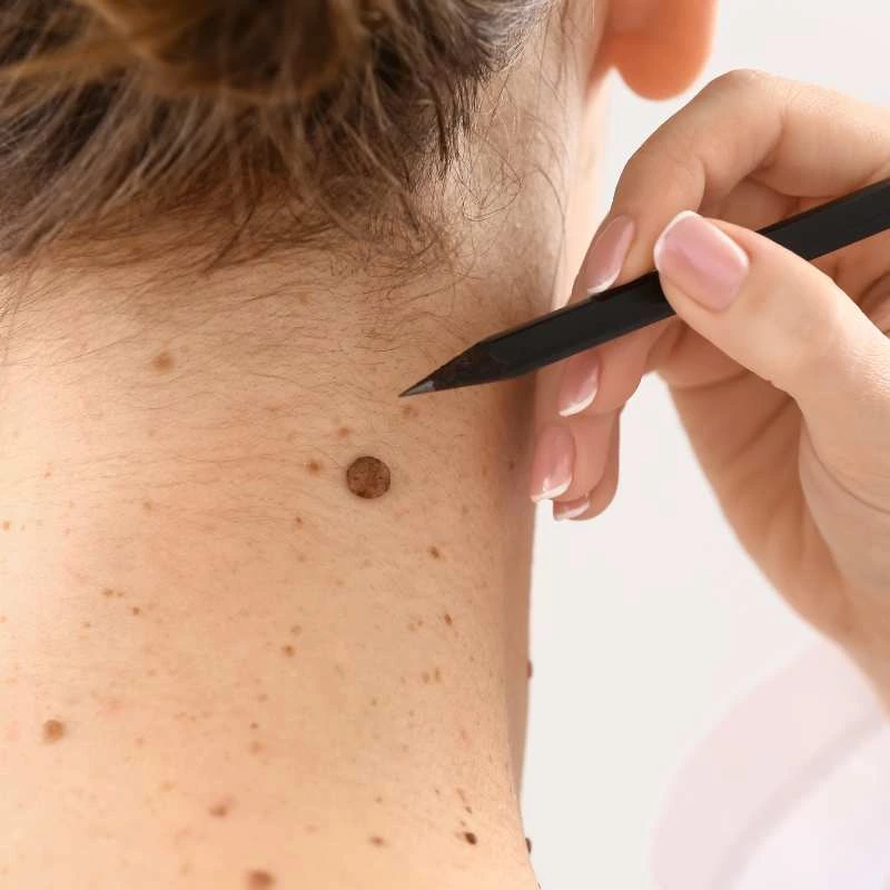 See our lesion removal prices Hanworth - call today for a free quote